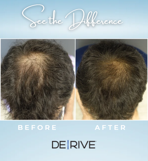 Before and after photos showing improved hair density and scalp coverage following DE|RIVE treatment, provided by the DE|RIVE manufacturer