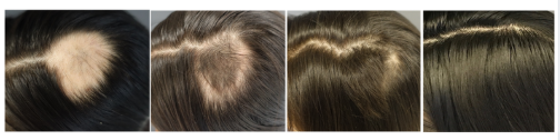 Progress photos of scalp coverage improvement across a series of DE|RIVE treatments, provided by the DE|RIVE manufacturer